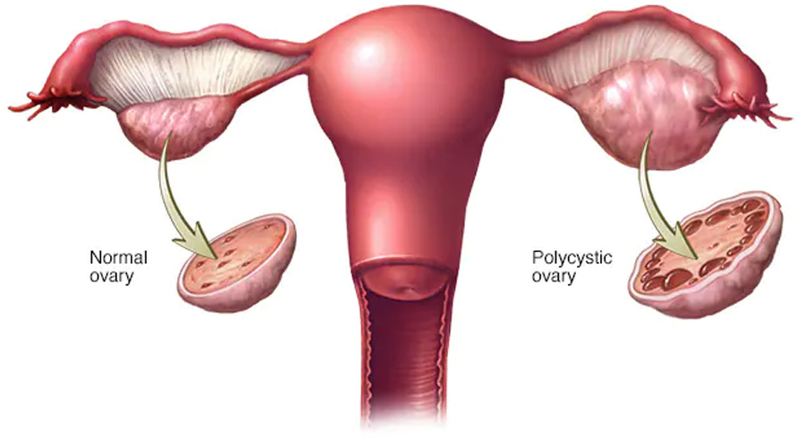 PCOS