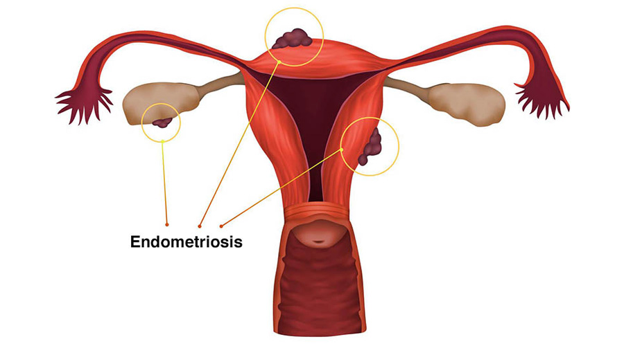severe endometriosis affect fertility