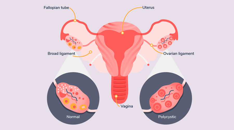 women's health, irregular menstrual cycle