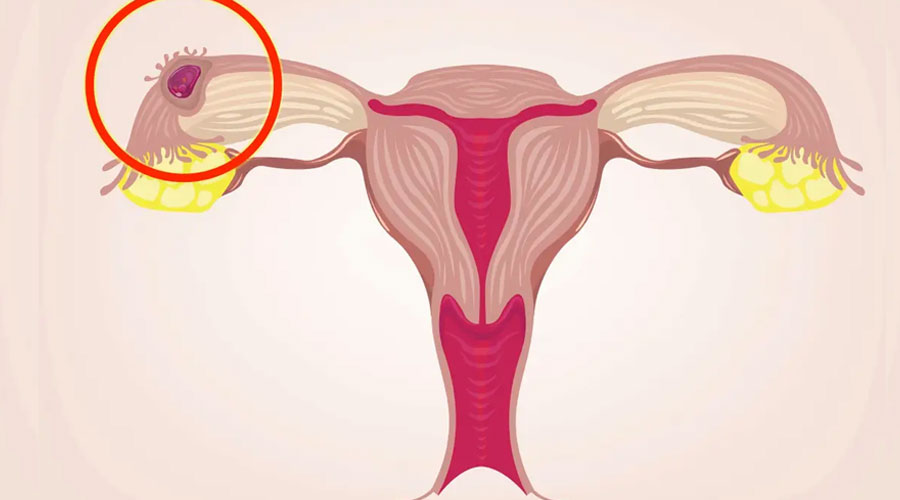 pelvic pain and vaginal bleeding can be symptoms of ectopic pregnancy 
